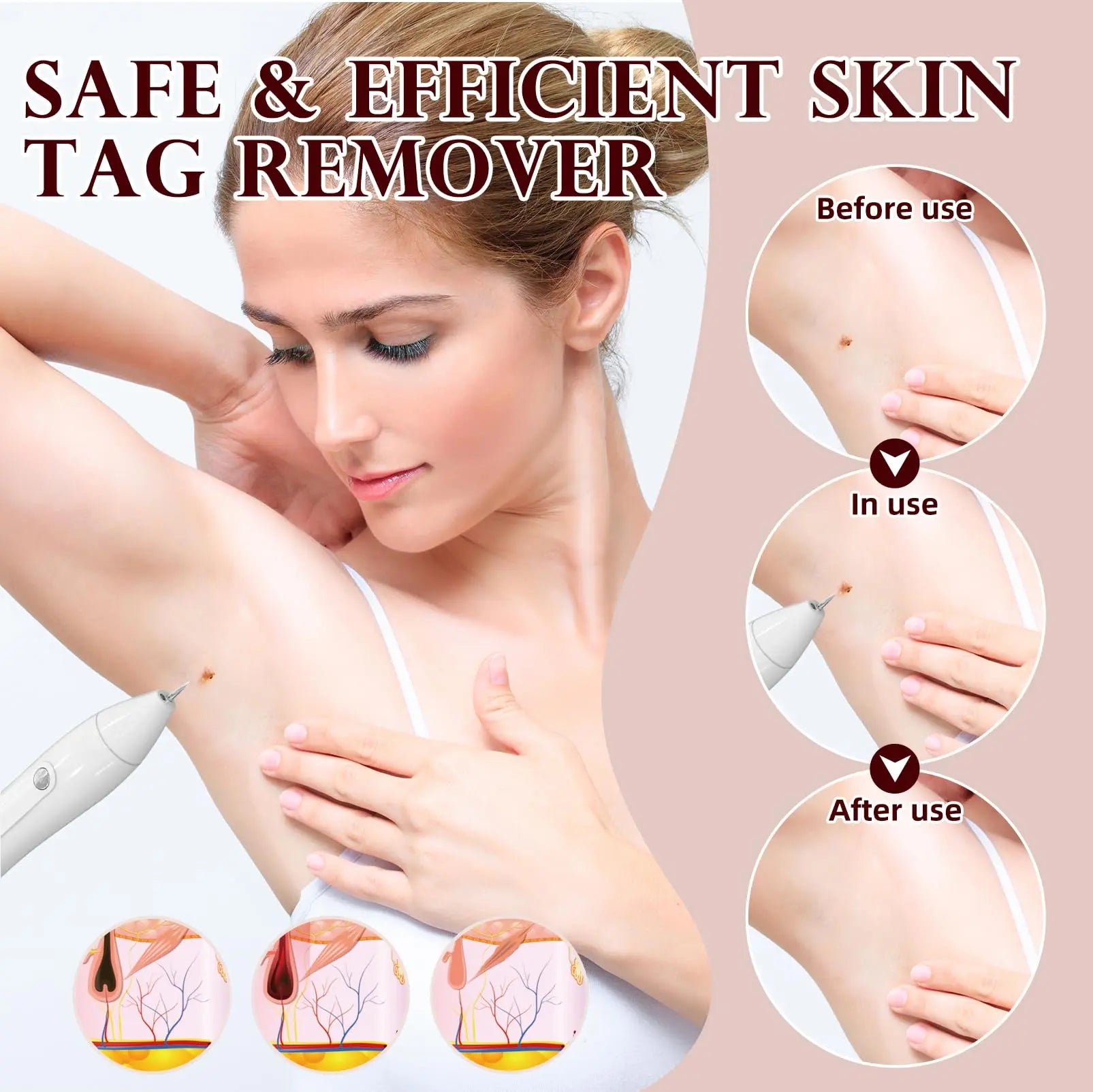 LM 1000 SkinTag Remover Home Use, Removal of Common Warts, SkinTags | Easy to Use Doba